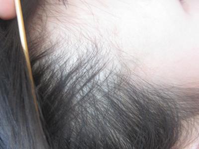 牛皮癣治疗需要多久才能好