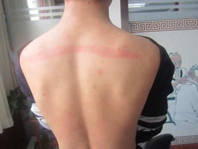 牛皮癣的危害有什么