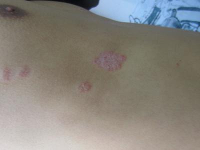 牛皮癣那些东西不能吃