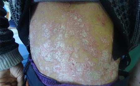 巴克玉夫膏是正规药吗