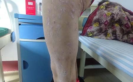 身上长了牛皮癣怎么办