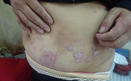 卡泊三醇软膏效果怎么样