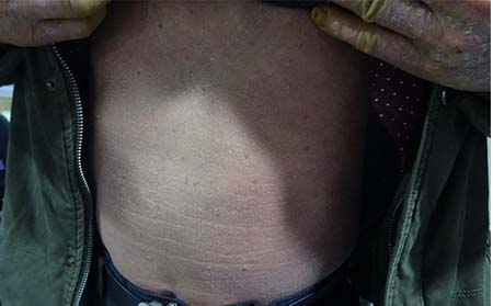 小孩患了牛皮癣应该如何调理呢