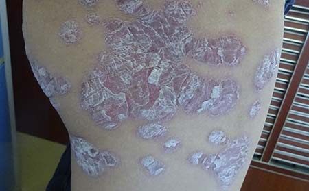 银屑病治疗好的方法有哪些