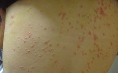 牛皮癣怎么治除根