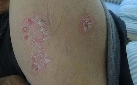 牛皮癣会产生什么伤害