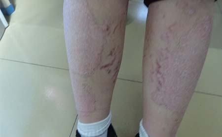 皮肤上的红斑是牛皮癣症状吗