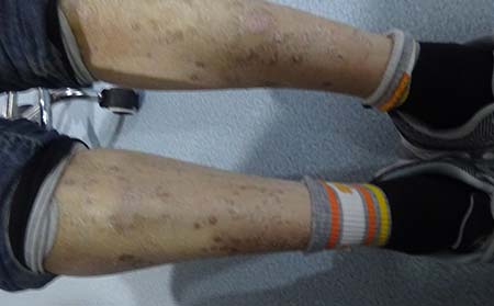 患有牛皮癣该怎样治疗