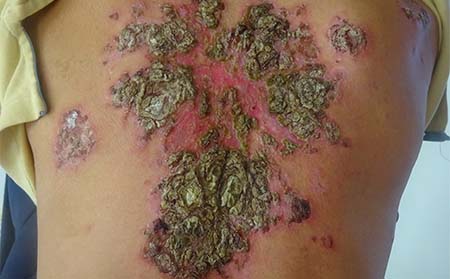 脸上有牛皮癣怎么护理好