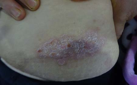 身上的牛皮癣需要怎样治疗