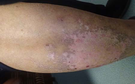 治疗牛皮癣有哪些注意事项