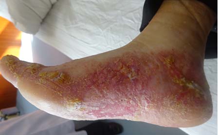 得了牛皮癣要怎么办