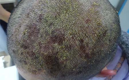 牛皮癣的治疗费用是多少