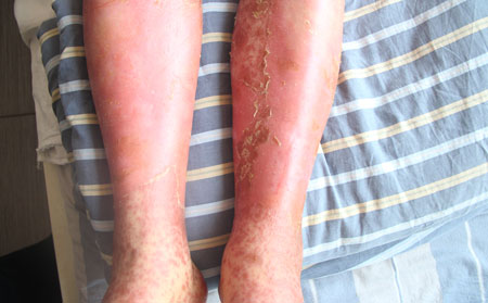 牛皮癣易扩散复发是什么原因