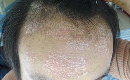 怎样才能更好的护理牛皮癣