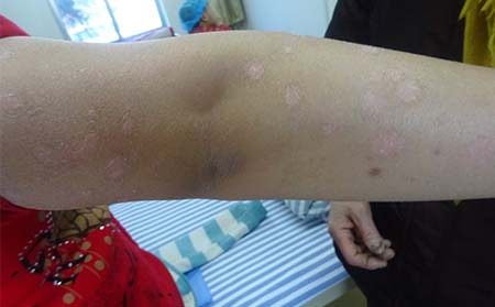 一起来看看如何医治牛皮癣