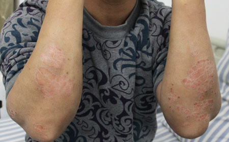 牛皮癣的常见病因是什么