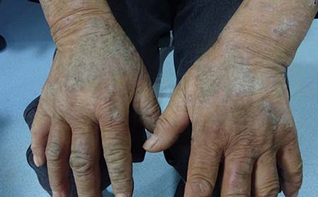 脸部牛皮癣红斑如何去除呢