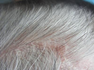 皮肤上长牛皮癣是因为什么