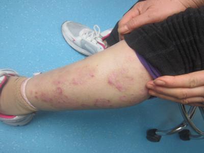 牛皮癣反复发作怎么办