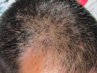 牛皮癣是由什么原因诱发的