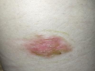 治疗牛皮癣的药有哪些