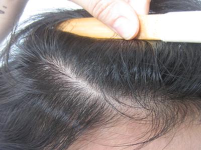 成都什么医院能治疗好牛皮癣