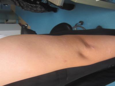 牛皮癣怎么治疗