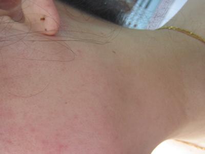 成都检查治疗牛皮癣需要多少钱