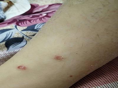 成都哪个医院看牛皮癣比较好