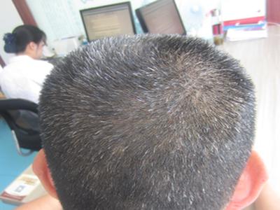 成都哪家医院治牛皮癣好