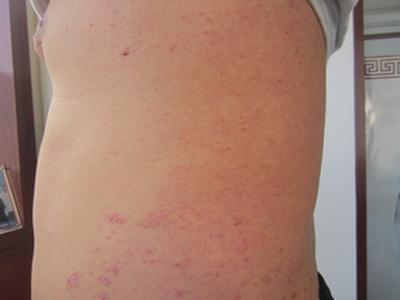 成都专业看牛皮癣的医院去哪家