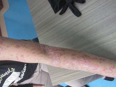 成都哪家医院治牛皮癣比较好