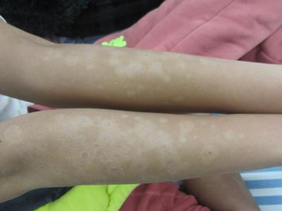 成都能治牛皮癣的医院去哪里