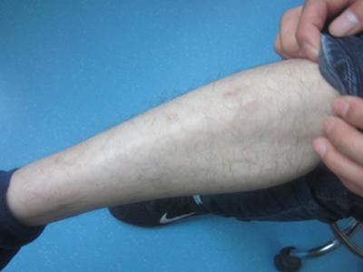 成都哪家医院看牛皮癣效果比较好