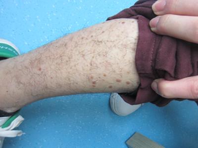 成都治疗牛皮癣比较专业的医院是哪