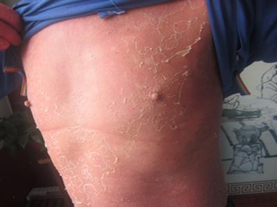 儿童牛皮癣有哪些护理方法