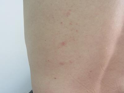 成都银康银屑病医院是骗人的吗