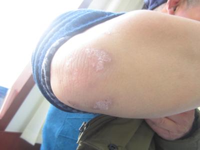 皮肤发红有鳞屑,得了牛皮癣是什么原因