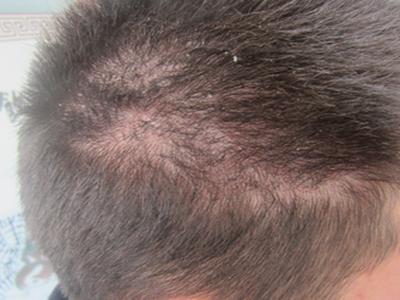 治疗牛皮癣科学的方法是什么