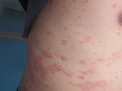 牛皮癣现在可以被根治吗