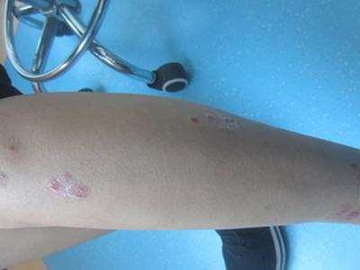 牛皮癣疾病有哪些特征