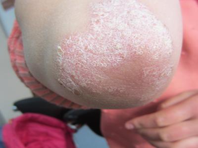 现在都有哪些方法治疗牛皮癣呢