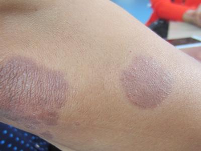 牛皮癣季节性复发是怎么造成的