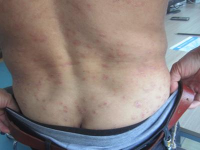 患有牛皮癣有哪些治疗方法