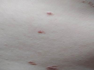 心情好坏会直接影响牛皮癣病情吗