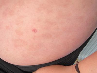 患上了牛皮癣该怎么办