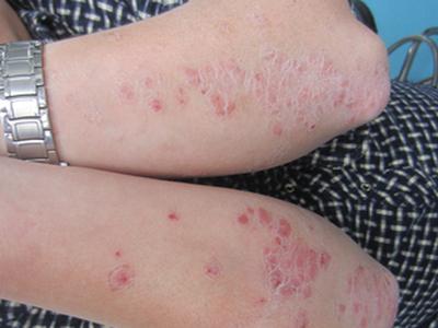 牛皮癣夏季治疗效果好吗