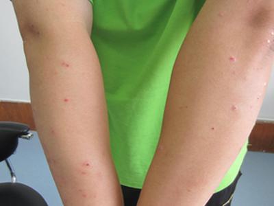 治疗牛皮癣的良方有什么