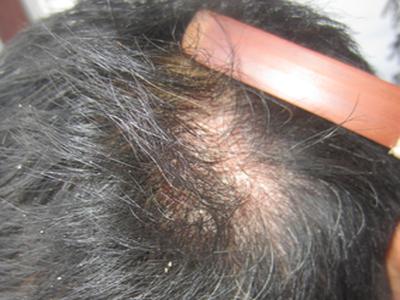 小腿上都是红疹子白皮是牛皮癣吗